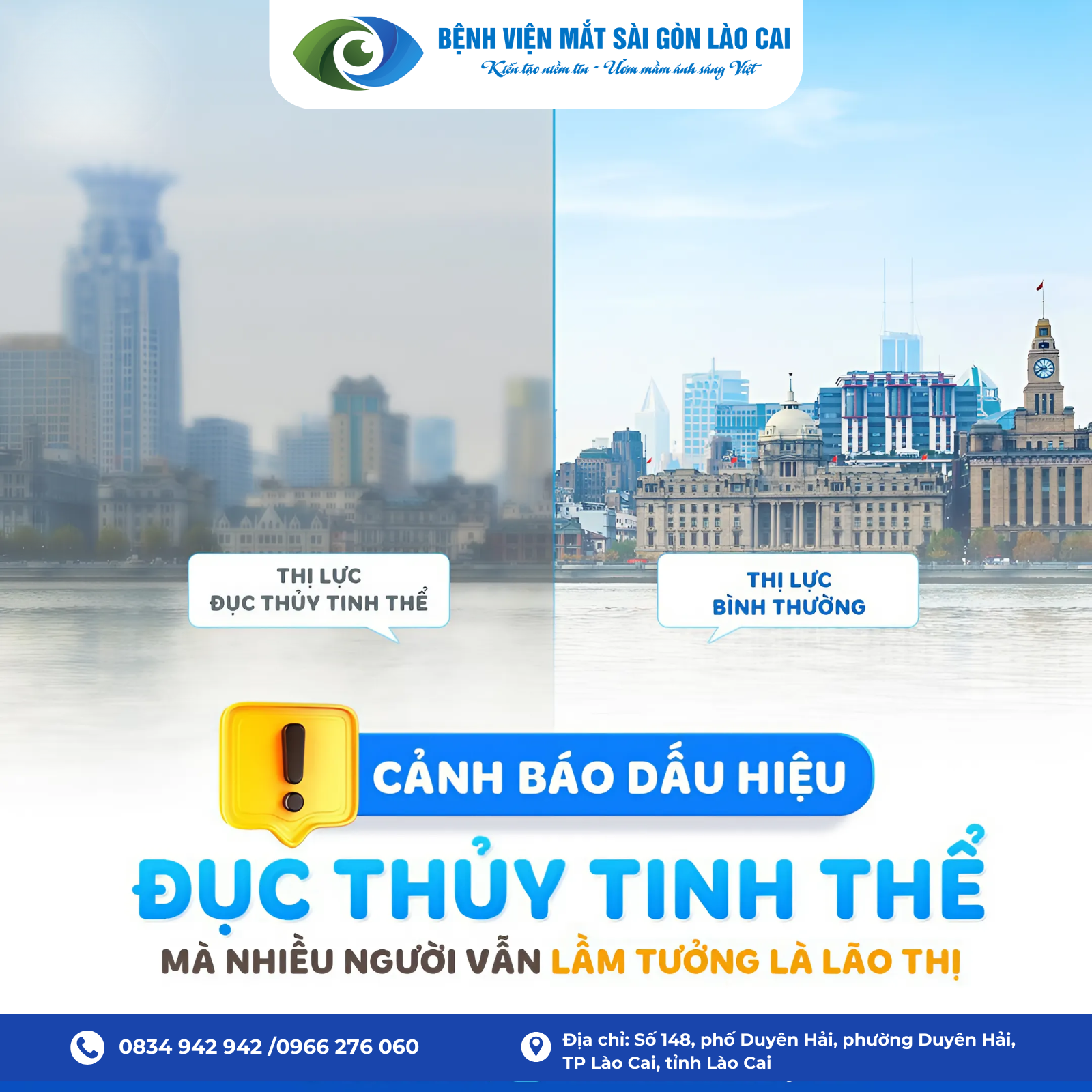 DẤU HIỆU ĐỤC THỦY TINH THỂ CÓ THỂ BẠN ĐANG NHẦM LẪN VỚI LÃO THỊ